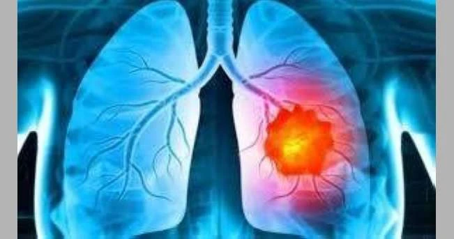 بريطانيا تبدأ اختبار أول لقاح لعلاج سرطان الرئة لايف ستايل لايف ستايل، بريطانيا تبدأ اختبار أول لقاح لعلاج سرطان الرئة،أصبح مريض بسرطان الرئة في