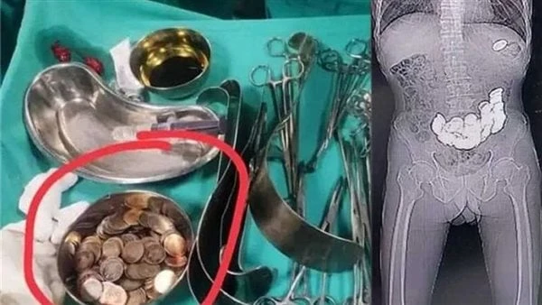 شهوة الغرائب.. إيراني يبتلع 3 كيلو جرام من القطع المعدنية.. شاهد أخرج الأطباء في إيران، 452 قطعة معدنية صغيرة، من معدة شخص يبلغ من العمر 37 عاما، و بلغ وزن القطع المعدنية 3 كيلوجرا