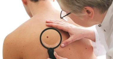 علامة متأخرة على سرطان الجلد قد تلاحظها أثناء صعود السلالم.. اعرفها صحة وطب شاهد المقال التالي من صحافة مصر عن علامة متأخرة على سرطان الجلد قد