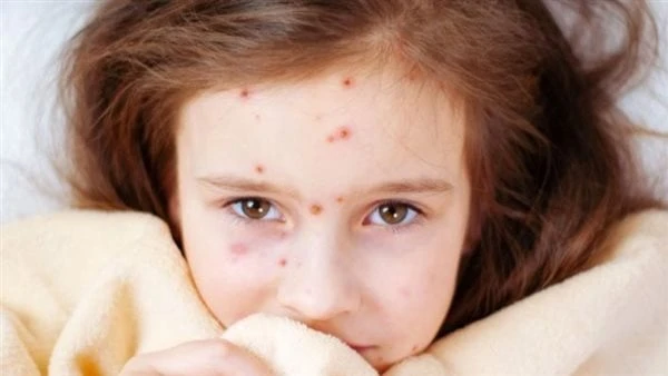 كل ما تريد عن الجدري المائي والفرق بينه وبين جدري القرود مع انتشار جدري القرود ، في عدد من دول العالم ولاسيما دول جنوب قارة افريقيا ، بادرت دول العالم علي تنفيذ توصيات الصحة العالم