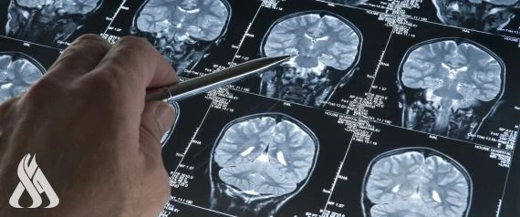 اكتشاف علمي جديد يكشف عن ميزة لدى مرضى ألزهايمر منوعات متابعة-واعكشفت دراسة جديدة عن ميزة لدى مرضى ألزهايمر، وذلك بعد إجراء تجارب على الفئران.وترجح الدراسة أن المصابين بألزهايمر أق