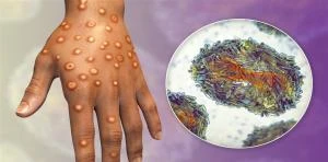 المغرب: إجراءات صارمة بعد تسجيل إصابات بجدري القردة صحة وجمال وكالات - السوسنةأعلنت وزارة الصحة والحماية الاجتماعية في المغرب بأنه تم تسجيل حالة