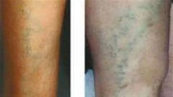 احترس من إهمالها.. مضاعفات خطيرة تصيبك عند إهمال علاج الدوالي تعد الدوالي من أكثر المشكلات الشائعة بين النساء وتصيب بعض الرجال وتنتشر بشكل خاص في القدمين والساقين.ووفقا لما جاء في