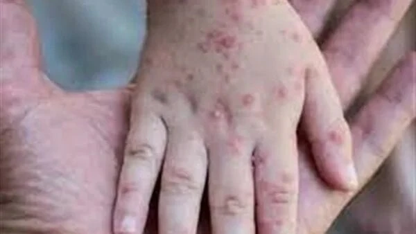 طرق الوقاية من جدري القرود خدمات خدمات طرق الوقاية من جدري القرود جدرى القرود زينب القاضي جدرى القرود.. يبحث الكثير من المواطنين عن طرق الوقاية من