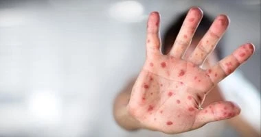 لماذا الأطفال أكثر عرضة للإصابة بمرض الجدري المائي من البالغين؟ صحة وطب الجدري المائي، يعد من الأمراض التي يصاب بها البعض وخاصة الأطفال والحوامل، والأشخاص الذين يعانون من ضعف الجها