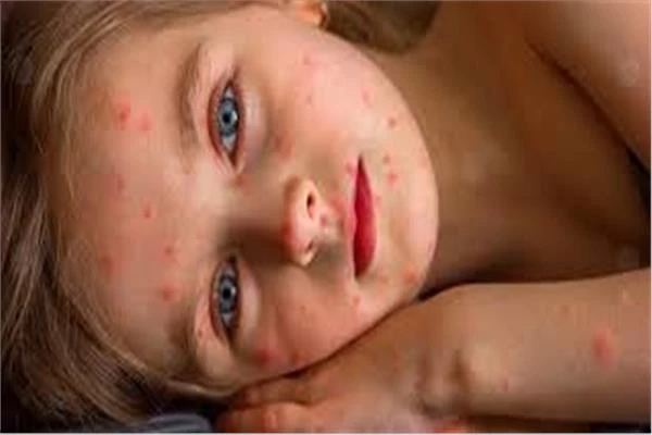 سلالة جديدة من جدري القردة تتسلل من الكونغو إلى تايلاند متفرقات سلالة جديدة من جدري القردة تتسلل من الكونغو إلى تايلاند سلالة جديدة من جدري القردة اكتشف علماء الأوبئة سلالة جديدة م