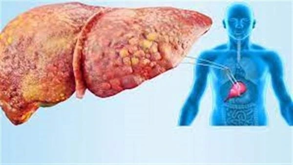 غير سي وبي.. أعراض غير متوقعة تكشف التهاب الكبد يحدث التهاب الكبد بسبب عدوى فيروسية تصيب الخلاياويمكن أن يؤثر على كفاءة عمل الكبد وكلما كان العلاج سريع كلما كان الشفاء أسرع.لا تظهر