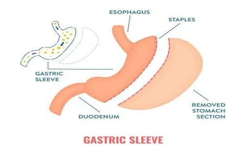 ما هي أضرار عملية تحويل مسار المعدة على المدى البعيد؟ دكتور أسامة خليل خدمات خدمات ما هي أضرار عملية تحويل مسار المعدة على المدى البعيد؟ دكتور أسامة خليل تكميم المعدة استطاعت عملية