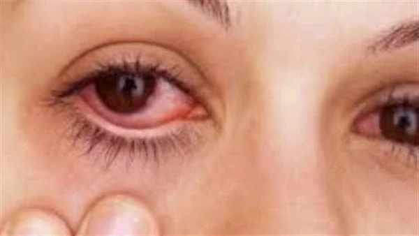 أطعمة وفيتامينات مهمة لمرضى إعتام عدسة العينعلى الرغم من كل الجهود المبذولة، فإن إعتام عدسة العين أمر لا مفر منه مع تقدم العمر، ومع ذلك، يمكن تأخيره بإدخال بعض الفيتامينات التي يتم