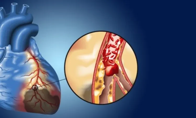 أكلات مهمة لعلاج انسداد الشرايين والوقاية من أمراض القلب صحة أصبحت أمراض القلب والأوعية الدموية وانسداد الشرايين، من المشكلات الصحية الشائعة بين عدد