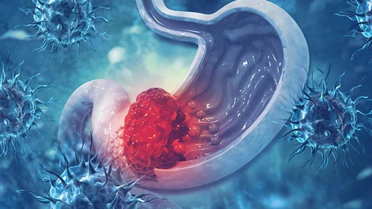 لا تتجاهلها.. 4 علامات خفية تشير إلى سرطان المعدة لايف ستايل كتبت- أسماء العمدة: سرطان المعدة هو مرض خطير يمكن أن يظهر تدريجيا دون أعراض واضحة في