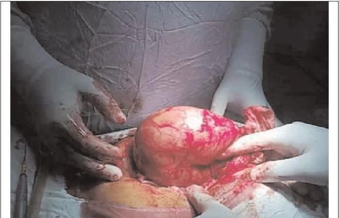 تشير علامة كورفوازيه، التي تسمى أحيانا قانون كورفوازيه، إلى وجود تضخم في المرارة نتيجة تراكم الصفراء، وعندئذ تمكن عادة رؤية المرارة أو الشعور بها من خلال الجلد. تفرز المرارة الصفرا