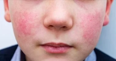 ما ستهونش بيه.. فيروس بارفو أو ما يطلق عليه الخد المصفوع يسبب الإجهاض صحة وطب قالت صحيفة ديلى ميل البريطانية، إن هناك ارتفاع مثير للقلق في حالات