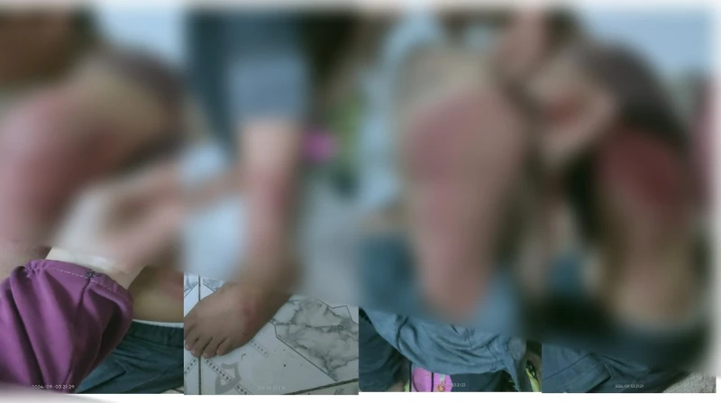 دكتورة جامعية تعتدي على طفل بخرطوم: جواه شيطان وهطلعه (صور) مأساة متكررة يعيشها الطفل يوسف عمرو، صاحب ال14 عاما، بعدما تعرض لوصلة تعذيب معتادة على يد زوجة أبيه، التي تعهدت أمام زوج