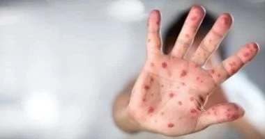 نصائح لحماية الحامل من الإصابة بجدري القرود صحة وطب جدري القرود هو عدوي فيروسية يصاب بها البعض، يعد من الأمراض المنتشرة هذه الفترة، والمسببة في قلق عالمي، وخلال هذا التقرير سنتعرف 