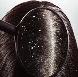 أمراض جلدية تثير القلق من بينها القشرة متفرقات قشرة الرأس مشكلة محرجة لدي الكثير في بعض الأحيان، ويمكن أن يكون سببها عوامل مختلفة، لكن ظهورها من الممكن ان يكون سببا في الاصابة بسرط