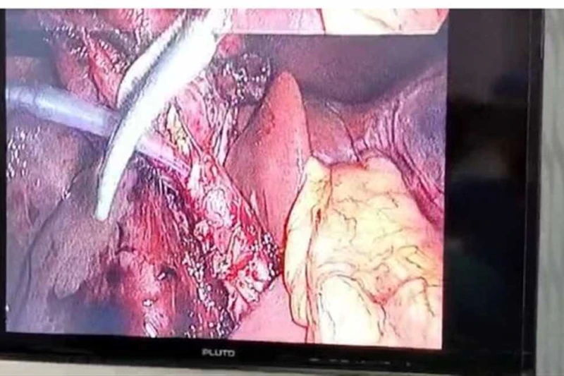 نجاح فريق مستشفى أبو قير في إجراء جراحة عاجلة لمريضة صفراء انسدادية بالإسكندرية (صور) نجح فريق الجراحة بمستشفى أبو قير العام فى الاسكندرية، لأول مرة،