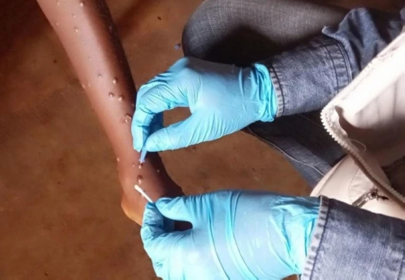 انتشار سريع في إفريقيا.. 5466 حالة جديدة لجدري القرود الحياة ينتشر فيروس جدري القردة (إمبوكس) بشكل سريع في القارة الإفريقية، بحسب المراكز الأفريقية