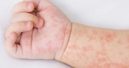 قال الدكتور علاء عبد العزيز، أخصائى طب الأطفال وحديثي الولادة بمستشفى الزقازيق، إن الحمى الوردية من الأمراض الشائعة عند الأطفال الرضع من عمر 6 شهور