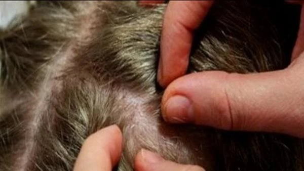 هيئة الدواء تطرح 3 نصائح ذهبية لمنع وتقليل انتشار قمل الرأسقمل الرأس من أكتر الحشرات التي تظهر في الصيف، وخاصة في فروة رأس الأطفال، وتسبب الشعور بحكة؛ ينتج عنها جروح في فروة الرأس،