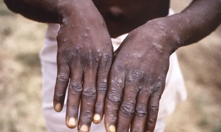 المغرب يعلن تسجيل أول إصابة بفيروس جدري القردة صحة اقرأ على الموقع الرسمي ختاما،نشير الى ان هذه هي تفاصيل المغرب يعلن تسجيل أول إصابة بفيروس جدري القردة ونشر عبر المصدر أهل مصر نرج