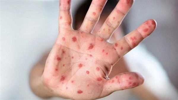 متى تبدأ أعراض جدري القرود في الظهور عليك؟تم التعرف على أول حالة مشتبه بها مرتبطة بجدري القرود في الهند في العاصمة دلهي، هذه هي الحالة الأولى في