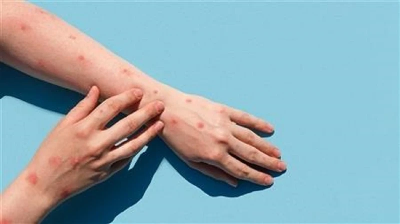 ما لم تعرفه عن وباء جدري القرود بعد ارتفاع الإصابات خلال الفترة الأخيرةما لم تعرفه عن وباء جدري القرود بعد ارتفاع الإصابات.. يعتبر جدري القرود من الأمراض المثيرة للقلق التي انتشرت