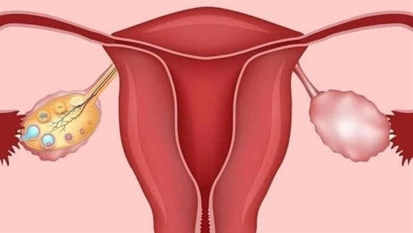 تعرف على علاج ضعف المبايض بالأعشاب قدم الدكتور خالد يوسف خبير التغذية العلاجية عبر صفحته الشخصية بموقع التواصل الاجتماعي فيسبوك، بعض الأعشاب لعلاج