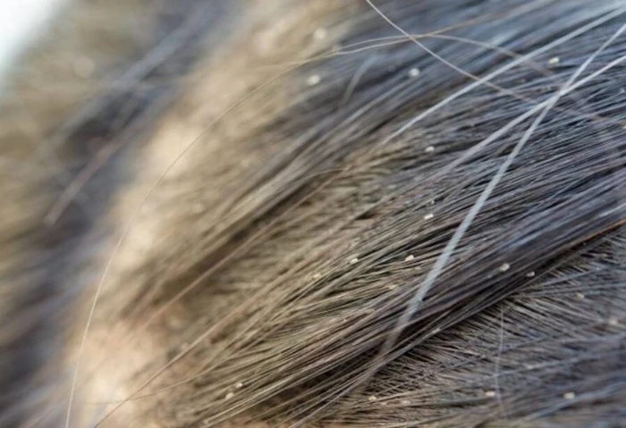 الصحة توجه 4 نصائح لمنع وتقليل انتشار قمل الشعر كشفت وزارة الصحة والسكان عن مجموعة من الإرشادات الهامة للحد من انتشار قمل الشعر، وذلك في إطار حملتها التوعوية استعدادا لبداية العام 