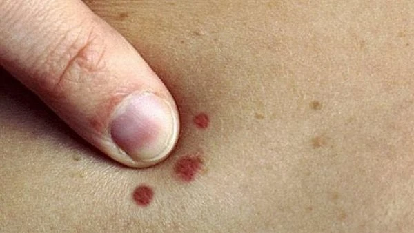 أعراض شائعة تدل على الإصابة بمرض سرطان الجلد..تعرف عليها بالصور يعد سرطان الجلد أكثر أنواع السرطانات شيوعا، ولكنه أيضا أحد أكثر الأمراض التي يمكن