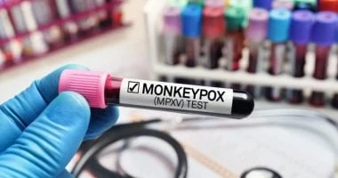 سلالات خطيرة من فيروس جدري القرود.. كيف تحمى نفسك منها صحة وطب جدرى القرود عدوى فيروسية كانت متوطنة سابقا في وسط وغرب أفريقيا، وتحولت إلى أزمة عالمية. وأعلنت منظمة الصحة العالمية ح