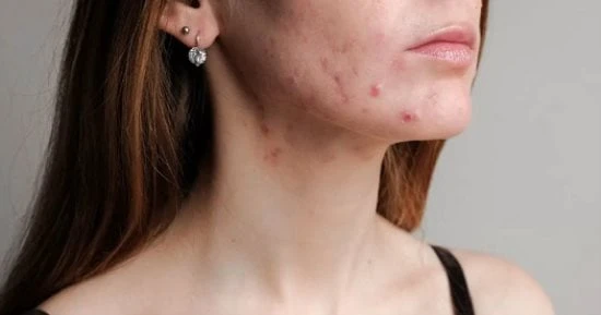 يعاني الكثير سواء فتيات أو شباب من مشكلة حب الشباب، وخاصة أصحاب البشرة الدهنية، وذلك لأن تلك البشرة تعاني من المزيد من الإفرازات للدهون، التي تتراكم مما يسبب البثور السوداء، والتي 