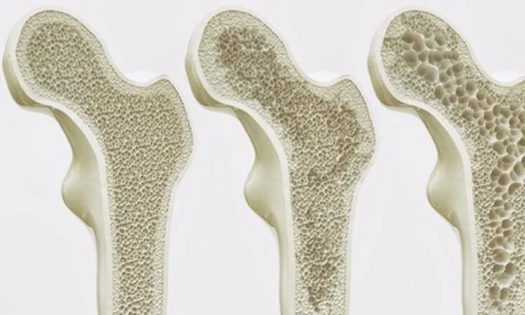 أكلات تزيد خطر الإصابة بهشاشة العظام.. خذ حذرك صحة تعتبر هشاشة العظام من المشكلات الشائعة بين عدد كبير من الأشخاص، خاصة كبار السن، حيث يزداد خطر