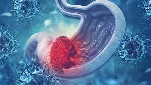 سرطان المعدة هو مرض خطير يمكن أن يظهر تدريجيا دون أعراض واضحة في مراحله المبكرة، لذا من المهم أن تكون على دراية ببعض العلامات التحذيرية التي تشير إلى
