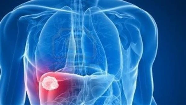 ما الأسباب وراء حدوث تليف الكبد؟.. رقم 2 الأخطريعتبر تليف الكبد هو تندب شديد يصيب الكبد، يمكن أن يحدث نتيجة أنواع كثيرة من أمراض وحالات الكبد، مثل التهاب الكبد أو إدمان الكحوليات ا