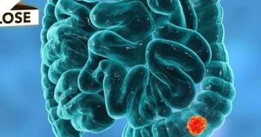 نوعان من الطعام يقللان الإصابة بسرطان الأمعاء صحة وطب تشير أبحاث جديدة إلى أن اللحوم والحليب قد يساعدان في الوقاية من سرطان الأمعاء، وفقا لموقع .