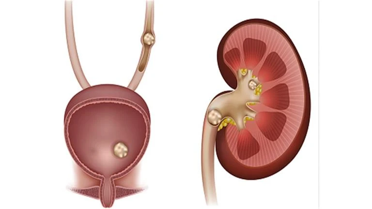 علاجات طبيعية تخلصك من حصوات الكلى لايف ستايل كتب سيد متولي يمكن لبعض العلاجات الطبيعية أن تمنع حصوات الكلى تلك الرواسب الصلبة التي تتكون في إحدى