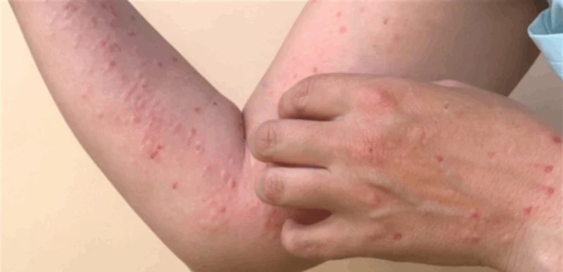 تفشي جدري القردة في أفريقيا خارج نطاق السيطرة صحة حذرت المراكز الأفريقية لمكافحة الأمراض والوقاية منها، الخميس، من أن تفشي جدري القردة في أفريقيا لا يزال خارج نطاق السيطرة، مضيفة أ