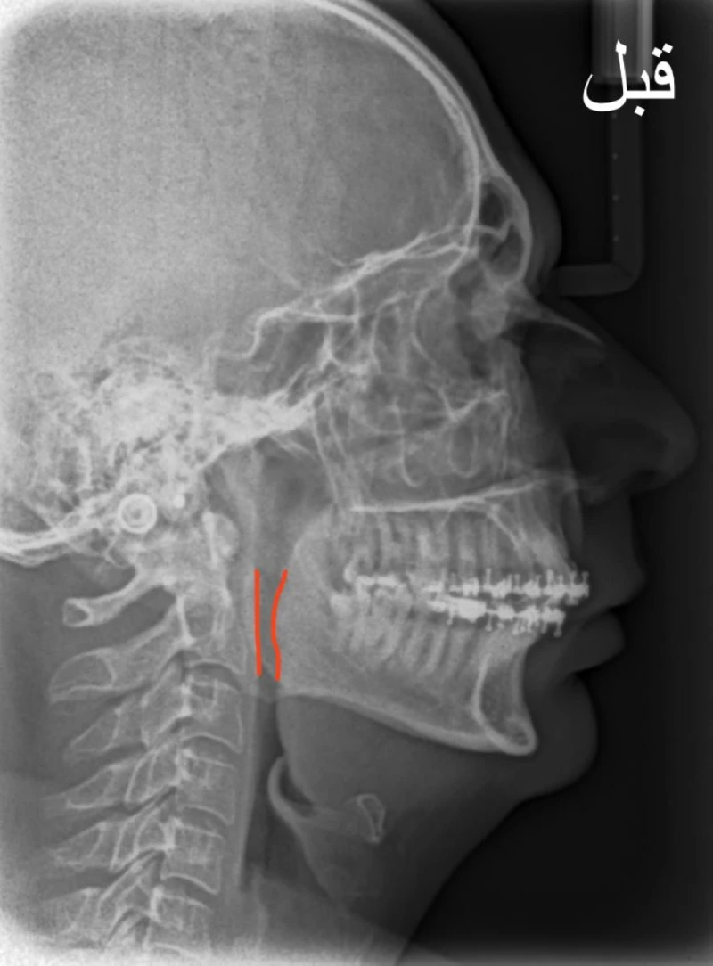 جراحة تنهي معاناة أربعيني من اضطراب النوم بسعود الطبية الحياة أنهت مدينة الملك سعود الطبية عضو تجمع الرياض الصحي الأول معاناة أربعيني عانى من اضطراب النوم؛ وذلك بإجراء تصحيح التطاب