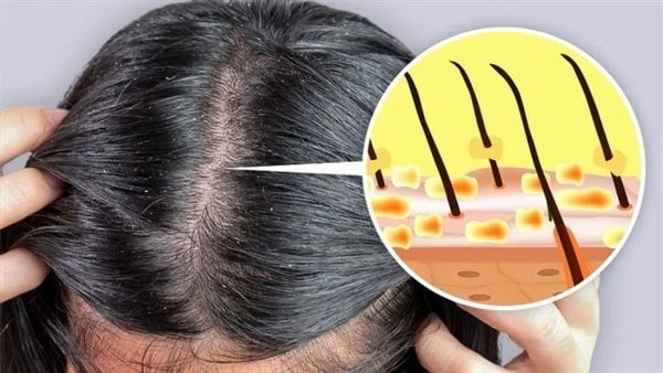 وصفات طبيعية للتخلص من قشرة الرأسنقدم لك أهم الوصفات الطبيعية للتخلص من قشرة الرأس، يمكن أن تساعد هذه الوصفات الطبيعية في التخلص من قشرة الرأس بفعالية وأمان، جربيها وستلاحظين الفرق