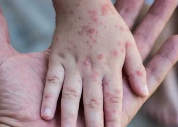 جدري القرود.. آخر التطورات وأعراض المرض وطريقة علاجه منوعات الاسبوع جدري القرود.. حالة من القلق الشديد سيطرت على المواطنين خلال الفترة الماضية بسبب