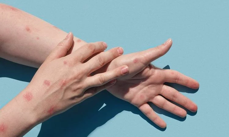 أهم ما يجب معرفته عن الإصابة بمرض جدرى القرود.. و نصائح للوقاية منه1. ما هو مرض جدري القرود؟جدرى القرود هو مرض نادر ينتج عن فيروس جدري القرود، وهو نوع من الفيروسات التي تنتمي إلى ع