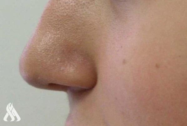 ورقة بحثية تحذر: نخر الأنف قد يمهد للإصابة بالخرف والزهايمر منوعات متابعة - واعأشارت دراسة بحثية جديدة، إلى أن نخر الأنف قد يكون له آثار صحية خطيرة