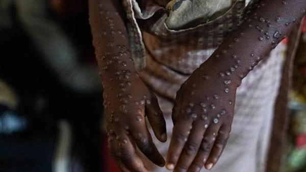 اللقاح وتجنب المخالطة.. كيف يمكن الوقاية من الإصابة بفيروس جدري القرود؟تم التعرف على أول حالة مشتبه بها مصابة بفيروس جدري القرود في الهند في العاصمة