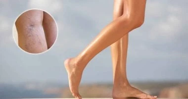 علاج الدوالي.. 7 طرق طبيعية هتساعدك فى تخفيف آلامك صحة وطب الدوالى أو الأوردة العنكبوتية، المعروفة باسم توسع الشعيرات الدموية، هي نتيجة لتلف الأوعية الدموية الصغيرة السطحية في الجل