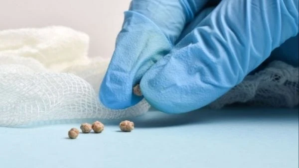 للحفاظ على صحتك.. اعرف أسباب وأنواع حصوات المرارة تعد حصوات المرارة من المشكلات الصحية الشائعة بين الرجال والنساء لذا من المهم معرفة أسبابها لتجنبها.ووفقا لما جاء في موقع مايو كلين