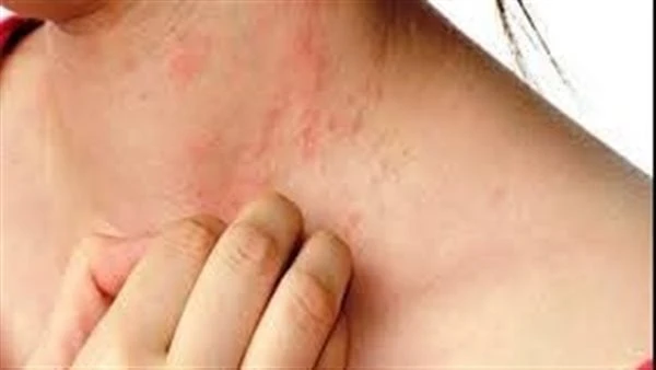 الإسعافات الأولية للطفح الحراري وأهم أعراضه الطفح الحراري هو تهيج جلدي يحدث بسبب التعرق المفرط أثناء الطقس الحار والرطب.ووفقا لما جاء في موقع مركز السيطرة على الأمراض وفقا لذلك نعر