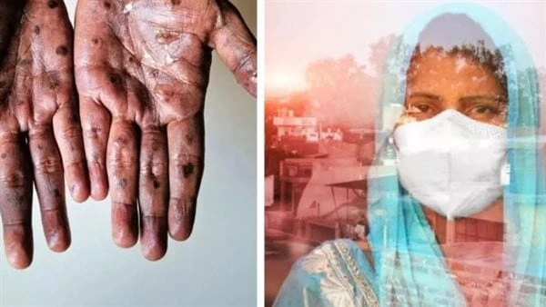 كيف يتم علاج فيروس جدري القرود ؟.. سوائل وأدوية مضادة للفيروساتيعتبر فيروس جدري القرود واحد من الأمراض النادرة، والجرذان والفئران والقرود من يصابون