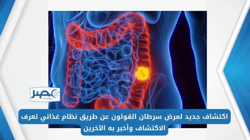 اكتشاف جديد لمرض سرطان القولون عن طريق نظام غذائي تعرف على الاكتشاف وأخبر به الآخريناكتشف الأطباء في بحث جديد أن تناول كميات كبيرة من السكريات دون تناول الألياف يؤدي إلى إنتاج بكتي
