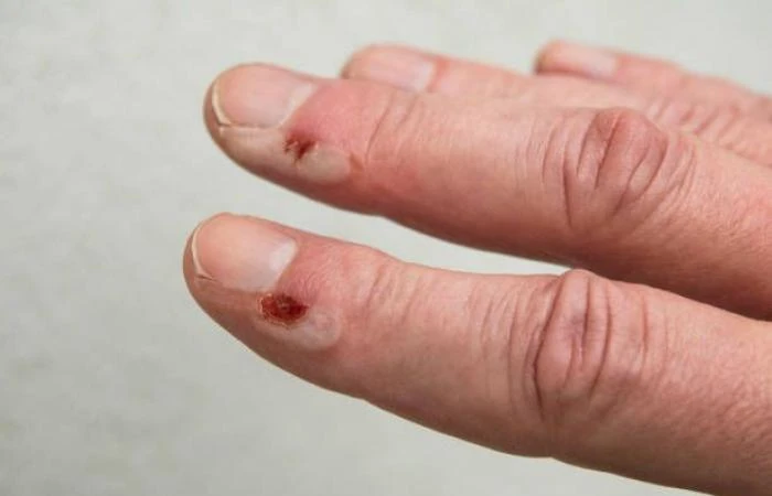 هو وهى انا اصدق العلم 0نشرإنشر فى إنشر فى إنشر فى أنشر فى إنشرها فى اماكن أخرىالاثنين 07 أكتوبر 2024 11:18 مساء0تبليغ متلازمة الجلد المسموط العنقودية أو المتحرق: الأسباب والأعراض و